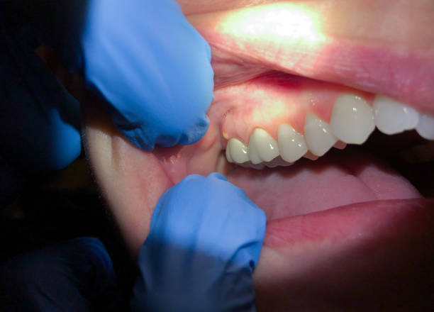 Emergency Dental Filling Replacement in TN